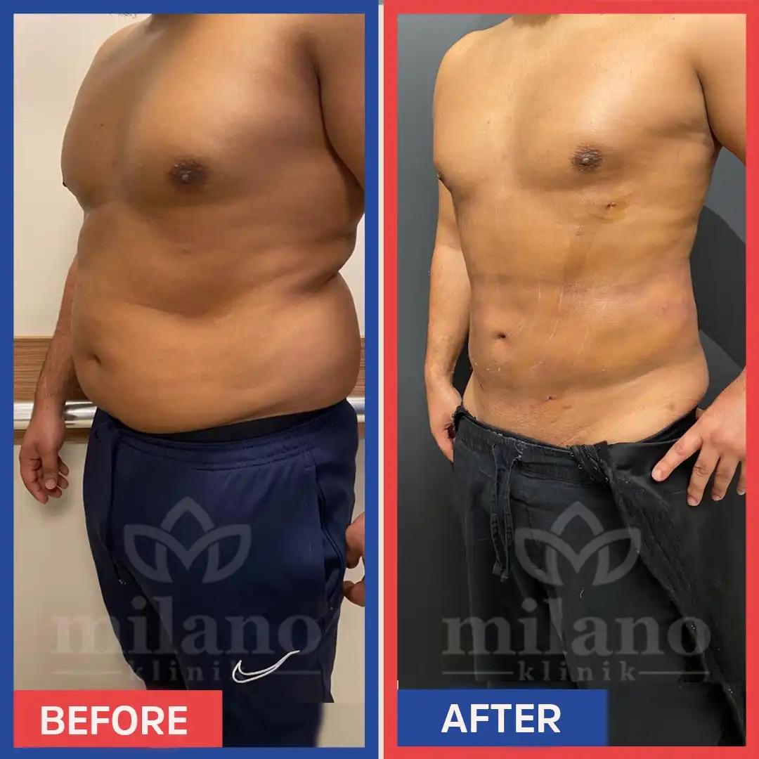 Slim Patch Minceur Hommes et Femmes